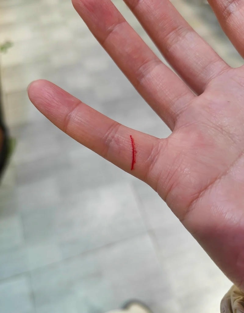 Ngón tay bị thương khi làm việc
