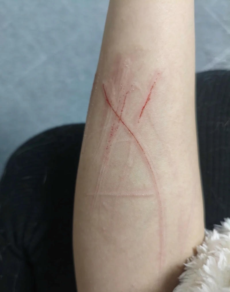 Hình ảnh chăm sóc vết thương ngoài da