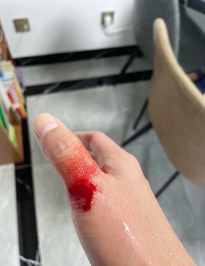 Vết thương ngoài da ở ngón tay