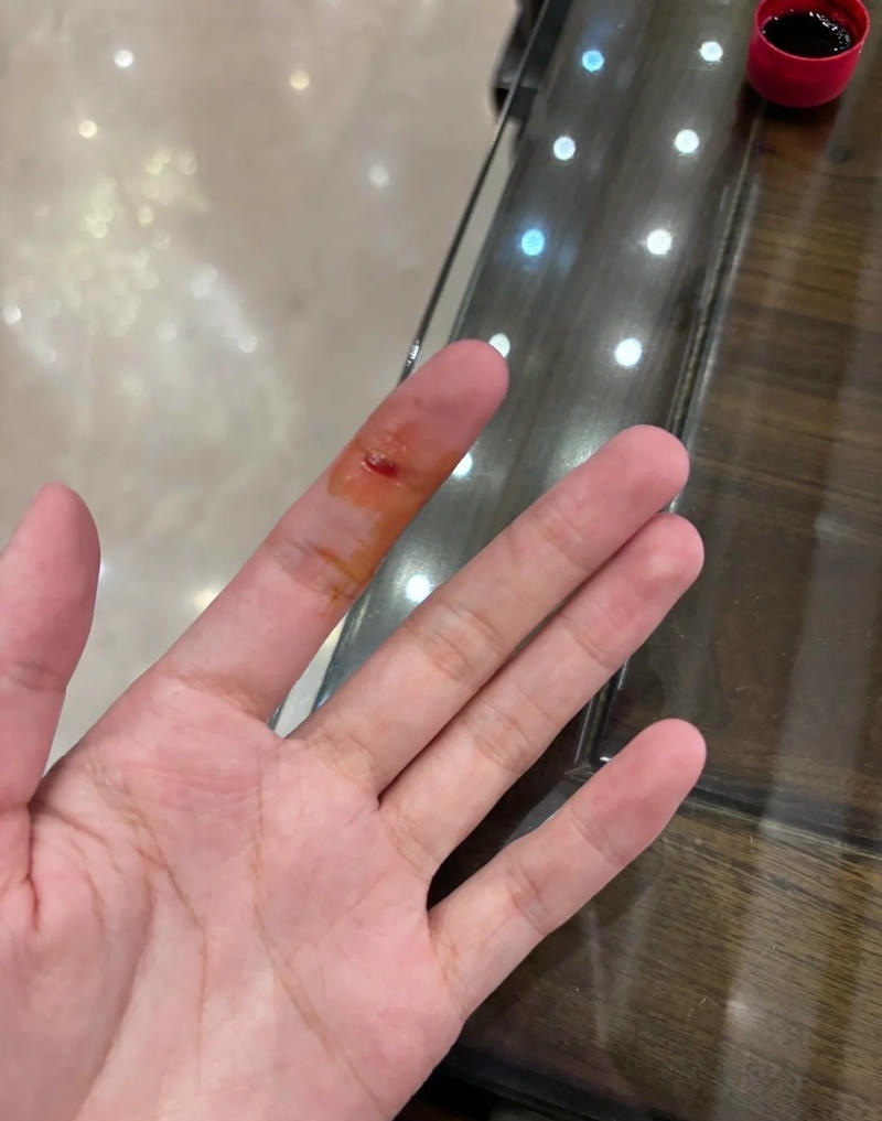 Cận cảnh vết thương trên bàn tay