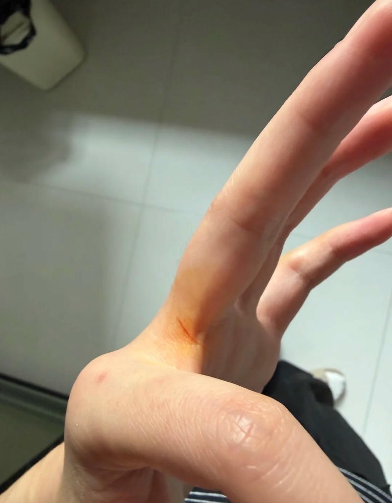 Hình ảnh sơ cứu vết thương ở tay