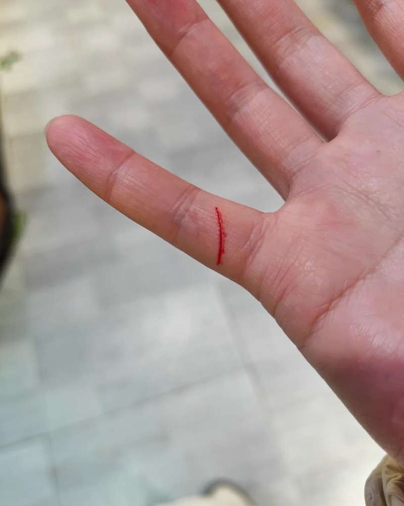 ảnh bị đứt tay 33