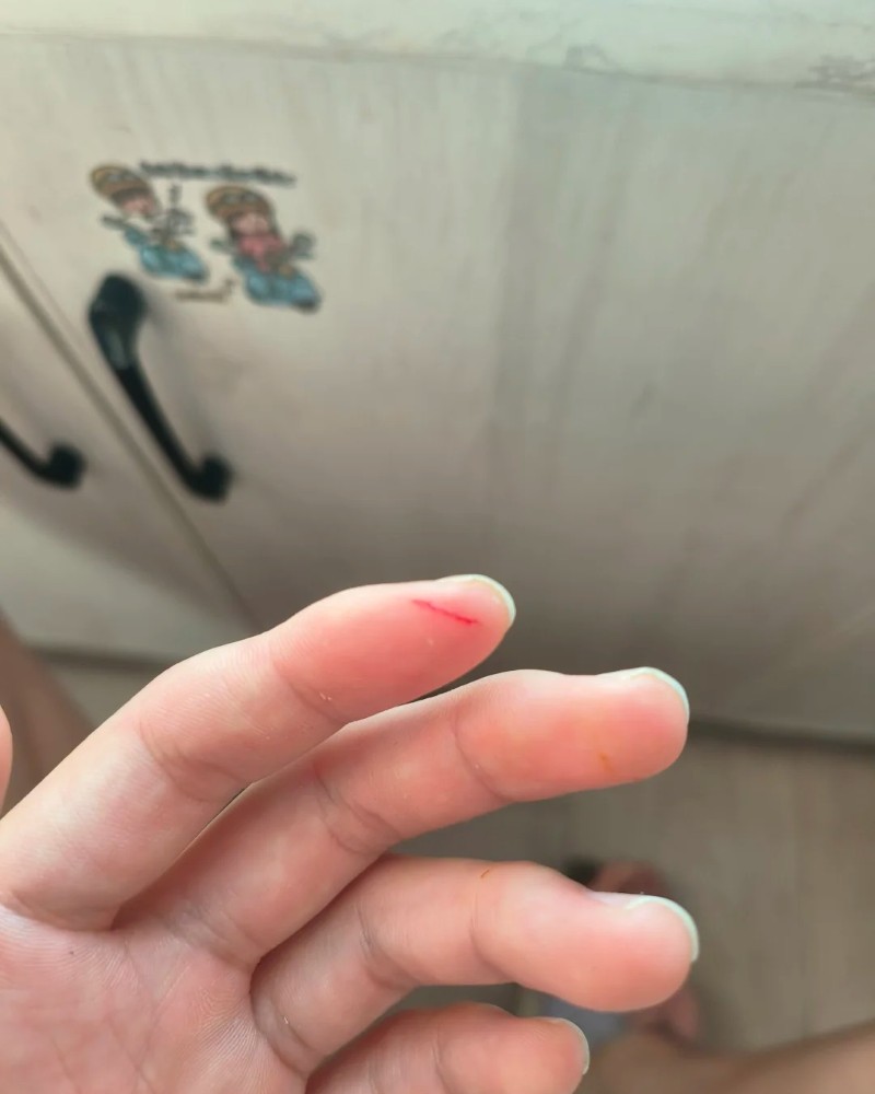 ảnh bị đứt tay 37