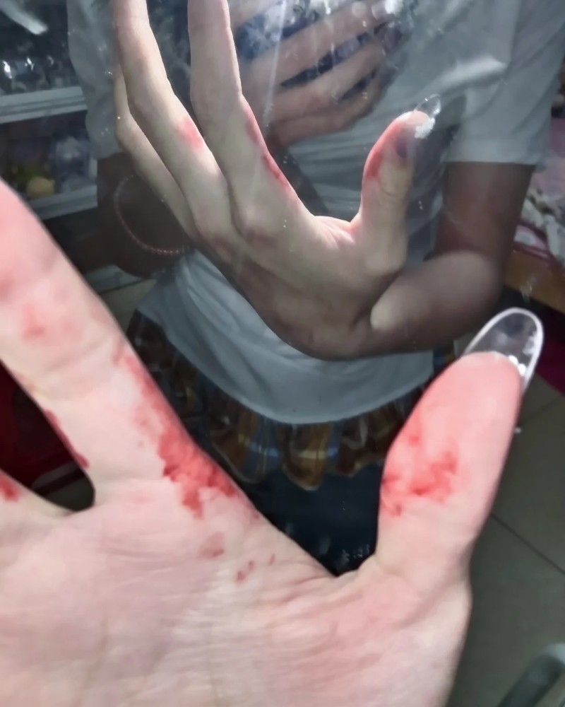 ảnh bị đứt tay 6