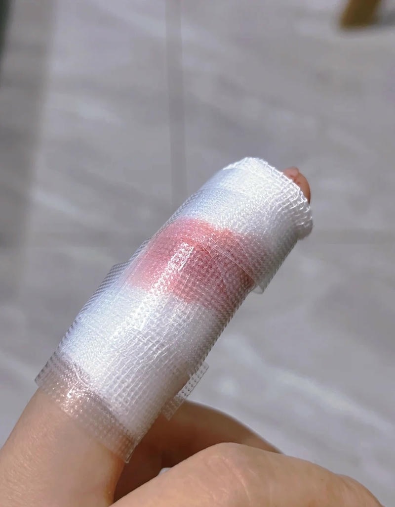 Ngón tay bị thương do dao kéo