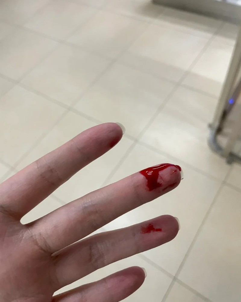 ảnh bị đứt tay 9