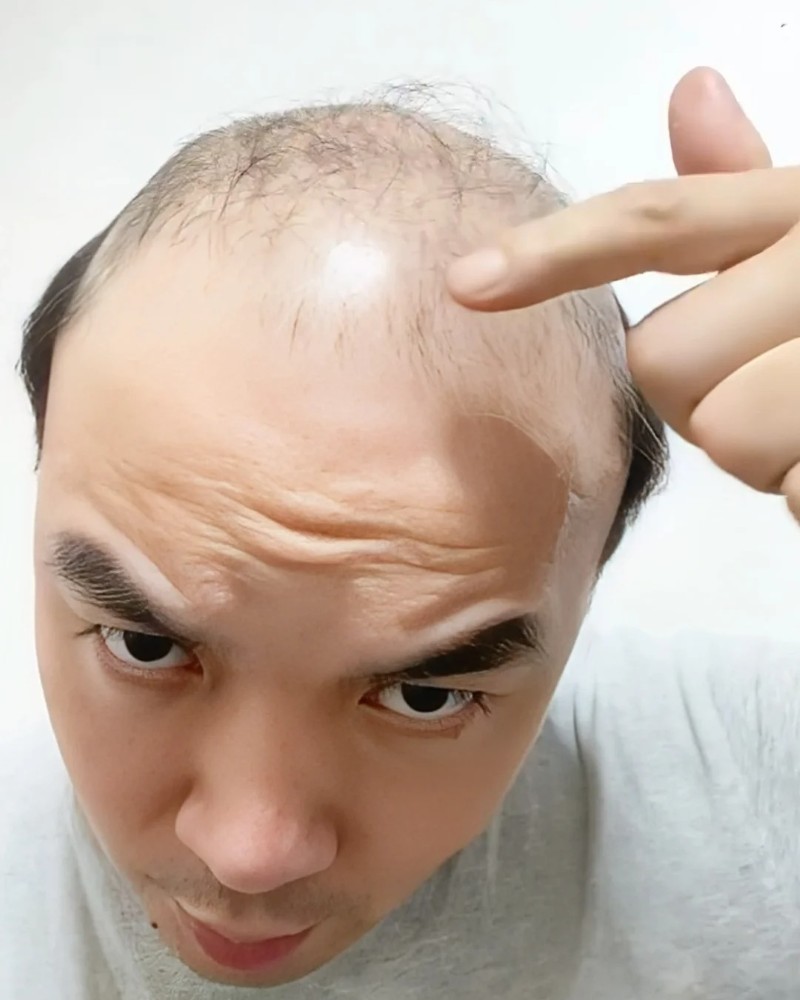 ảnh đầu trọc 2