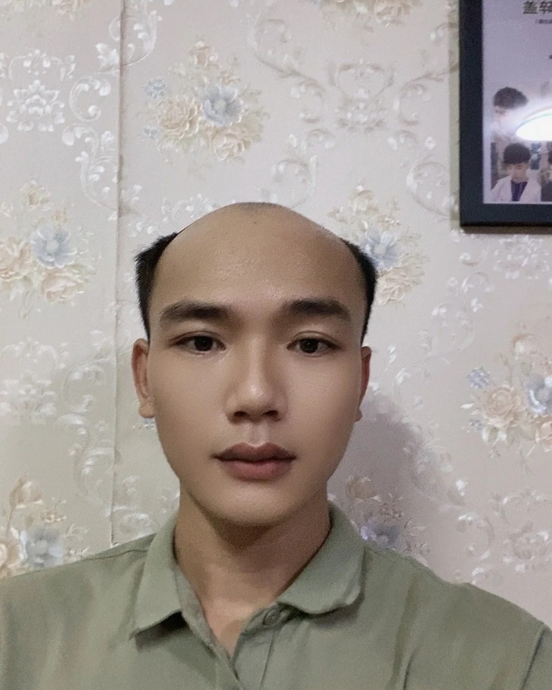ảnh đầu trọc 33