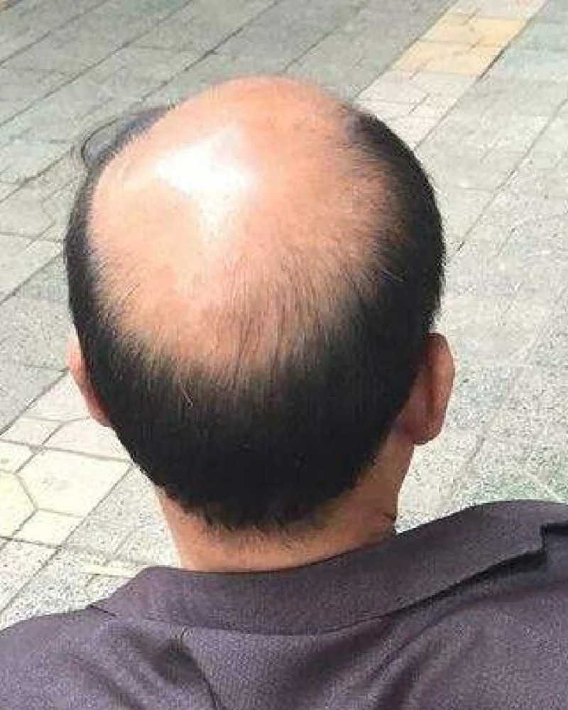 ảnh đầu trọc 34