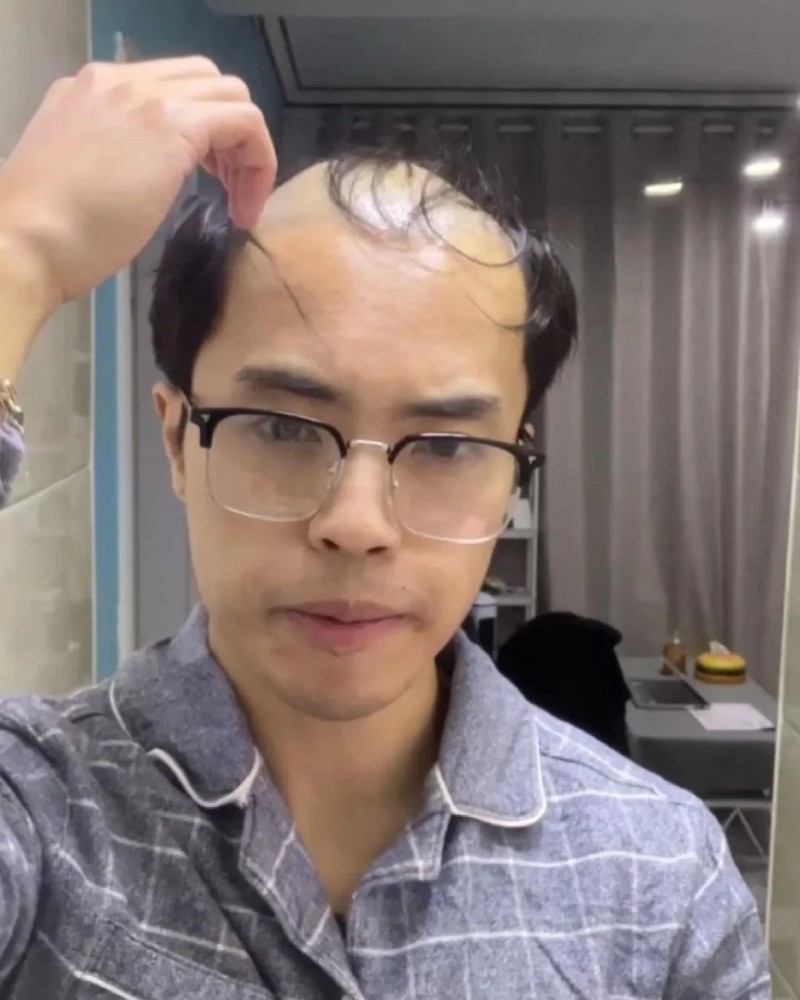 ảnh đầu trọc 35