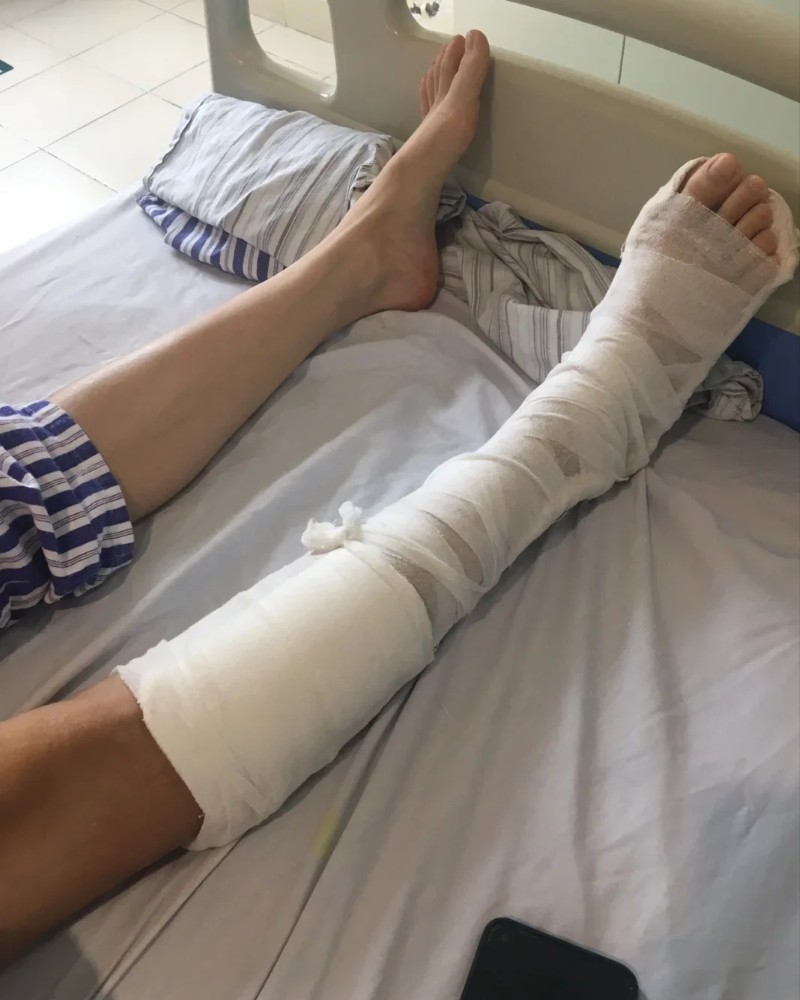 ảnh gãy chân 23
