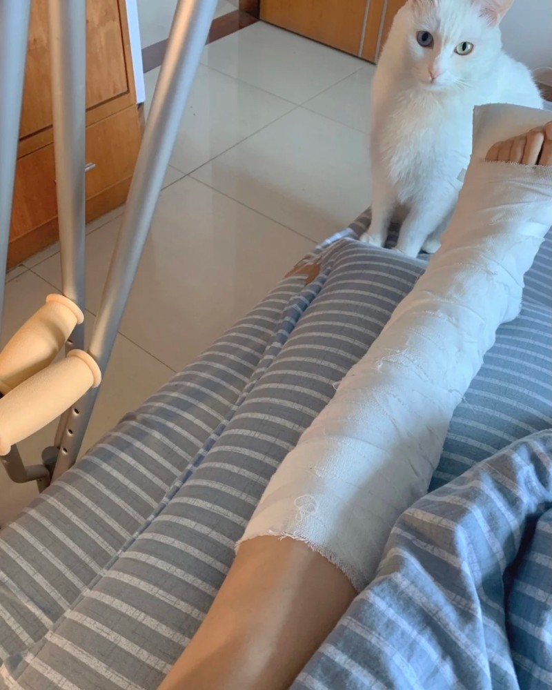 bó bột ảnh gãy chân nằm viện