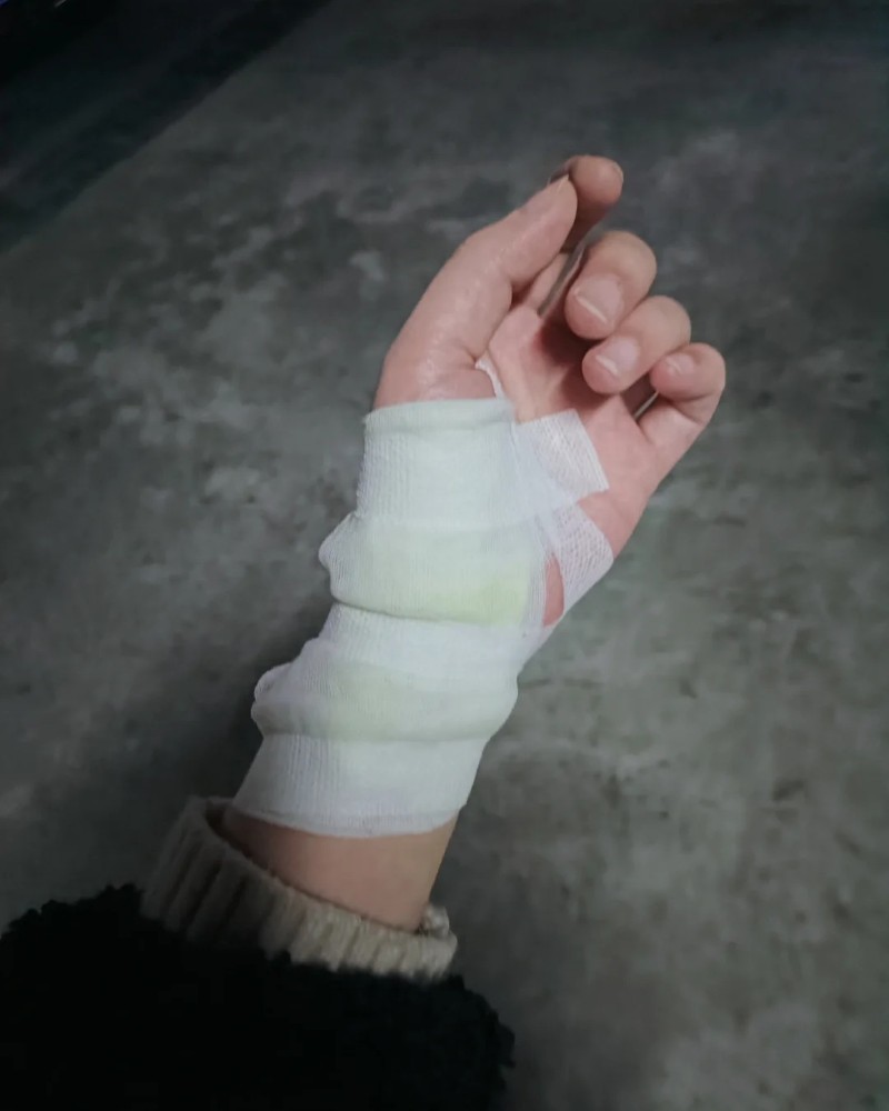 hình ảnh cắt gân tay