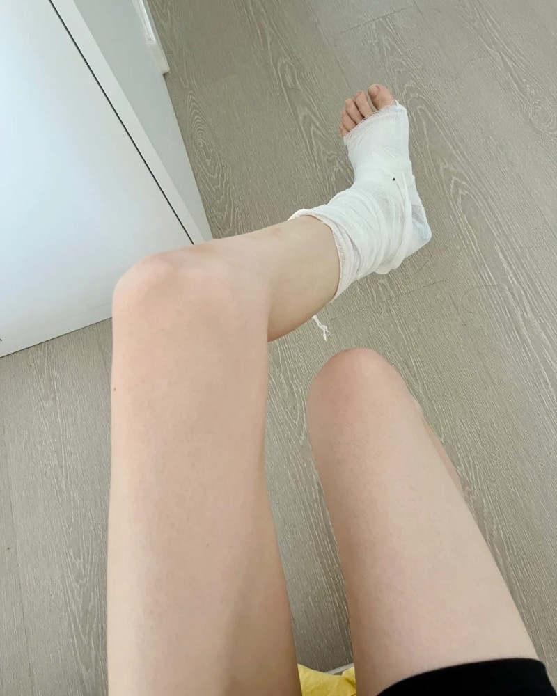 hình ảnh gãy chân băng bột